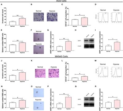 A-Kinase Interacting Protein 1 Promotes Cell Invasion and Stemness via Activating HIF-1α and β-Catenin Signaling Pathways in Gastric Cancer Under Hypoxia Condition